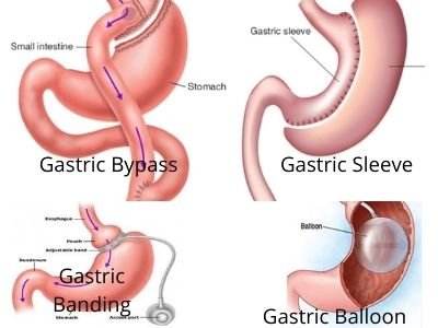 Bariatric Surgery